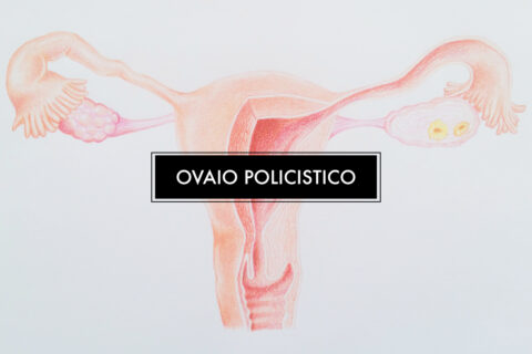 La dieta per ovaio policistico